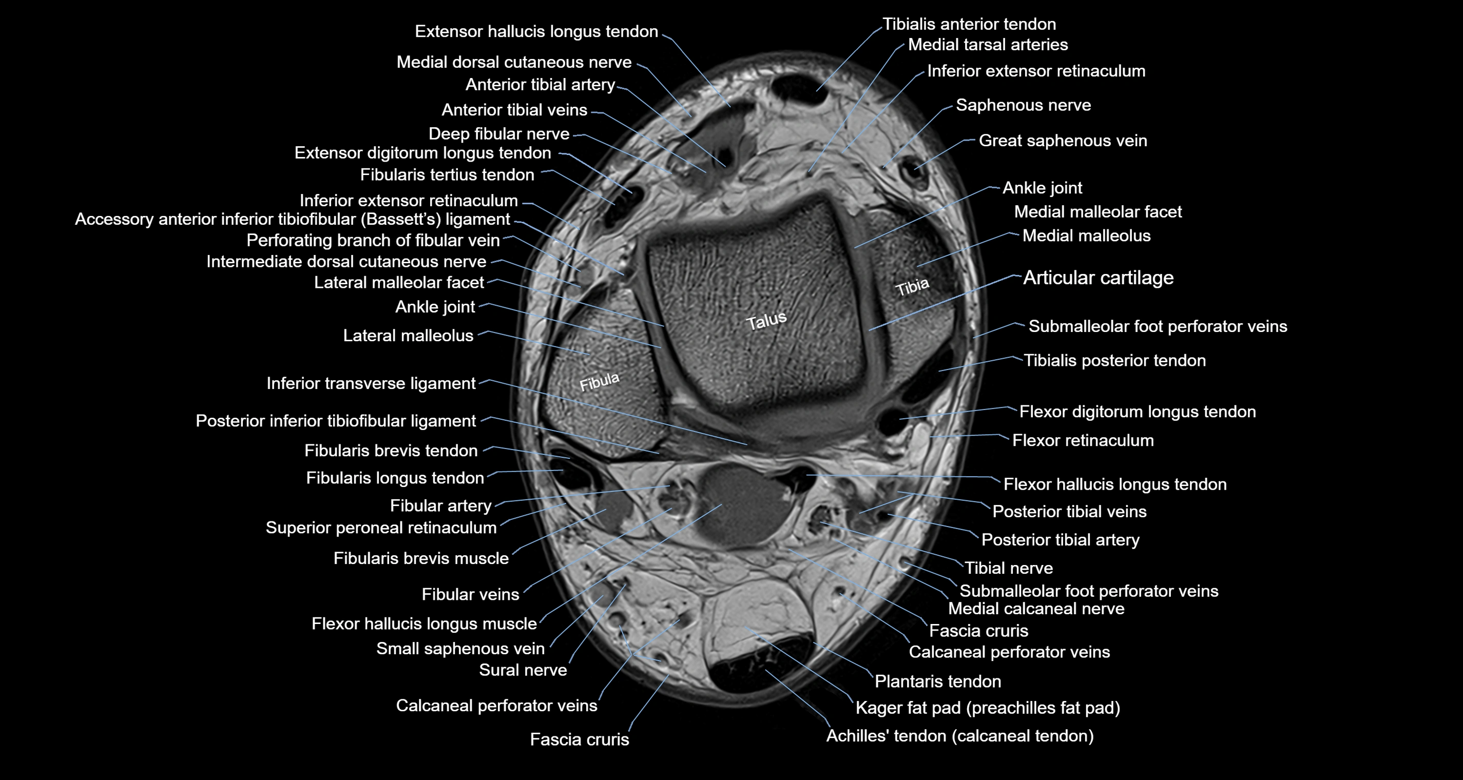 Ankle axial anatomy 3T MRI images -img-10001-00014.webp